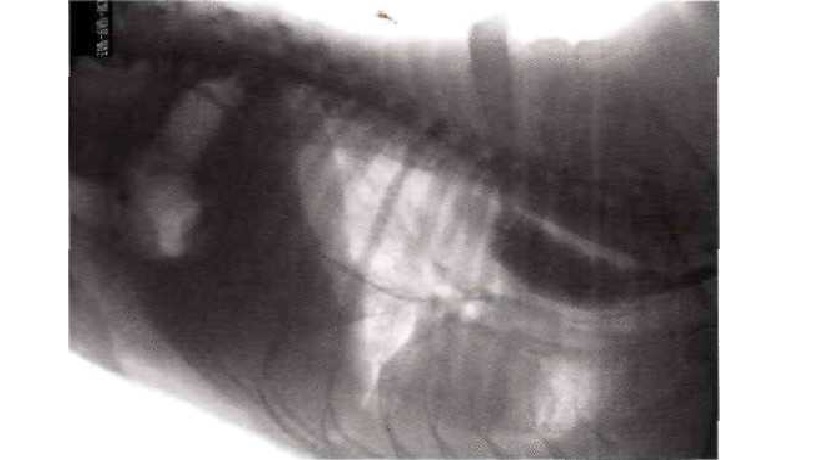 Осмотр пищевода. Рентген задержка контраста в пищеводе. Мегаэзофагус при незакрытом артериальном протоке.